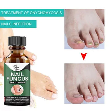 Foot Nail Fungus Treatment Serum – Antifungal Nail Repair Serum for Healthy Nails